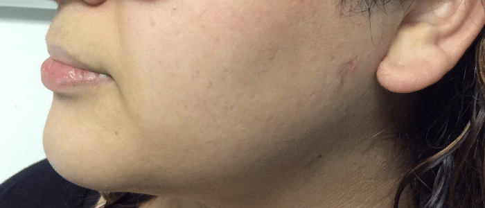 Laser-Hair-Removal-Face-After-1-1