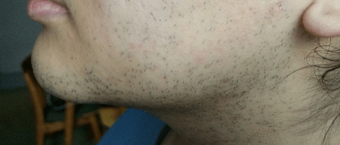 Laser-Hair-Removal-Face-Before-1-1